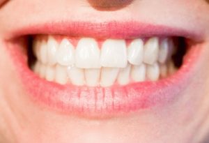 Teeth whitening systems at Dental Partners of Boston