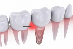 Inflamed gums around a dental implant leads to peri-implant disease