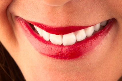 Close-up of dental veneers on a women smiling