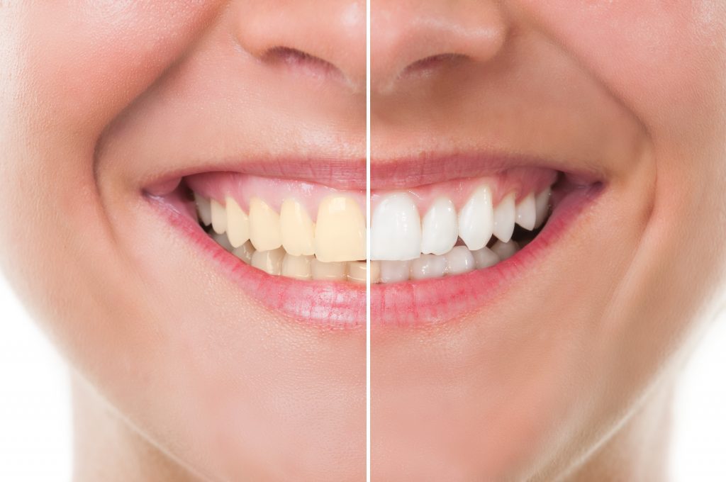 A side by side comparison of what teeth whitening can do to improve your smile from Dental Partners of Boston