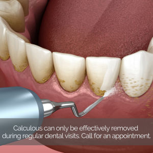 3D illustration of dental calculus removal