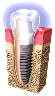 Vector cross section of a dental implant in the jaw