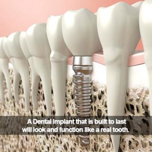 Dental implant vector. Caption: A dental implant is build to last and function like a real tooth.