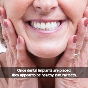 Woman smiling. Caption: Dental implants appear healthy and natural