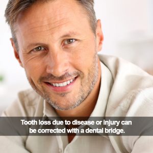 Man smiling. Caption: A dental bridge can correct tooth loss due to disease or injury.