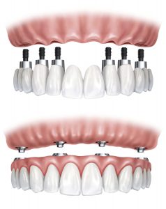 A 3D rendering of dental Implants