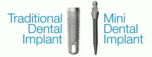 Mini Dental Implants vs a standard implant.