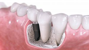 Periodontal cross section showing the roots of teeth and a dental implant.