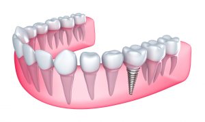 Teeth in a Day in Boston