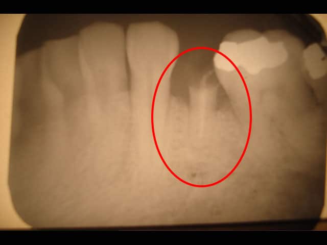 An x-ray of an Immediate dental implant in the case of a dental emergency