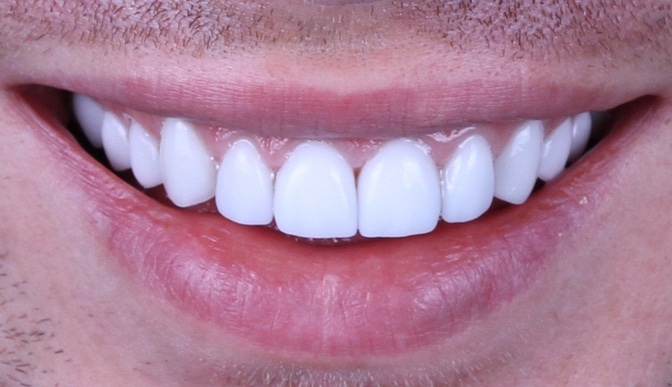 tandlampor för att få tänderna att se större ut