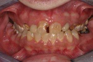 Severely damaged teeth from vaping