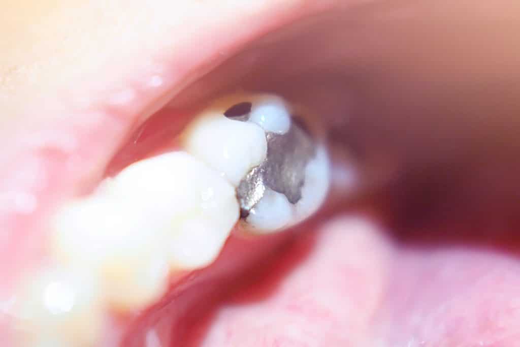 Inside of a mouth with a tooth that has a metal filling