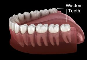 Wisdom teeth illustration