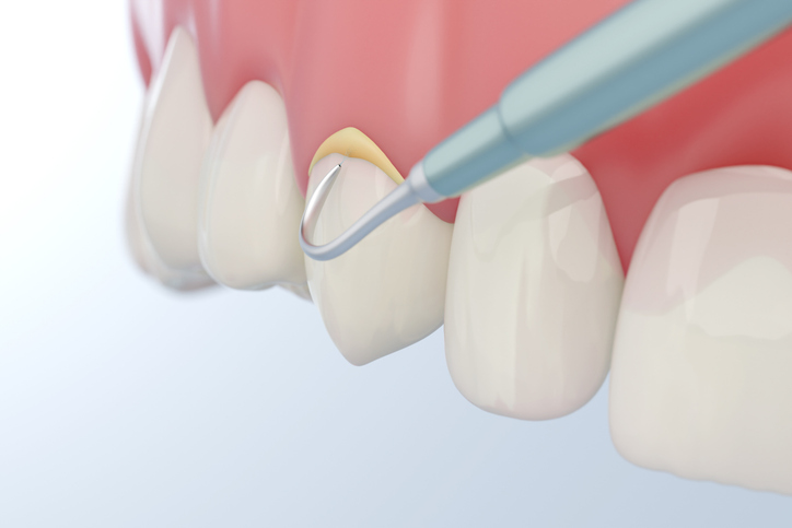 Dental tartar or plaque removal, 3D rendering.