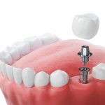 dental implant 3d rendering