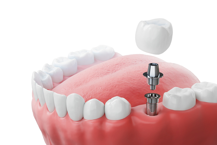 showing the parts that make up a dental implant