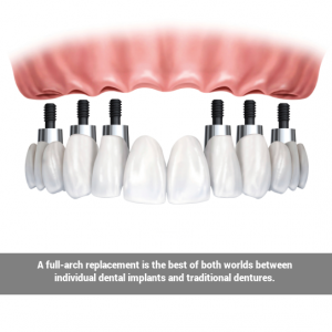 Photo realistic image of dental implants