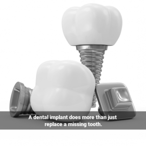 Phot realistic image of dental implants