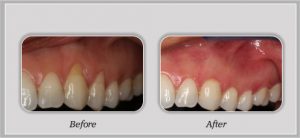 Pinhole Gum Surgery before and after