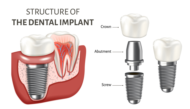 Educational poster showing a structure of the dental implant