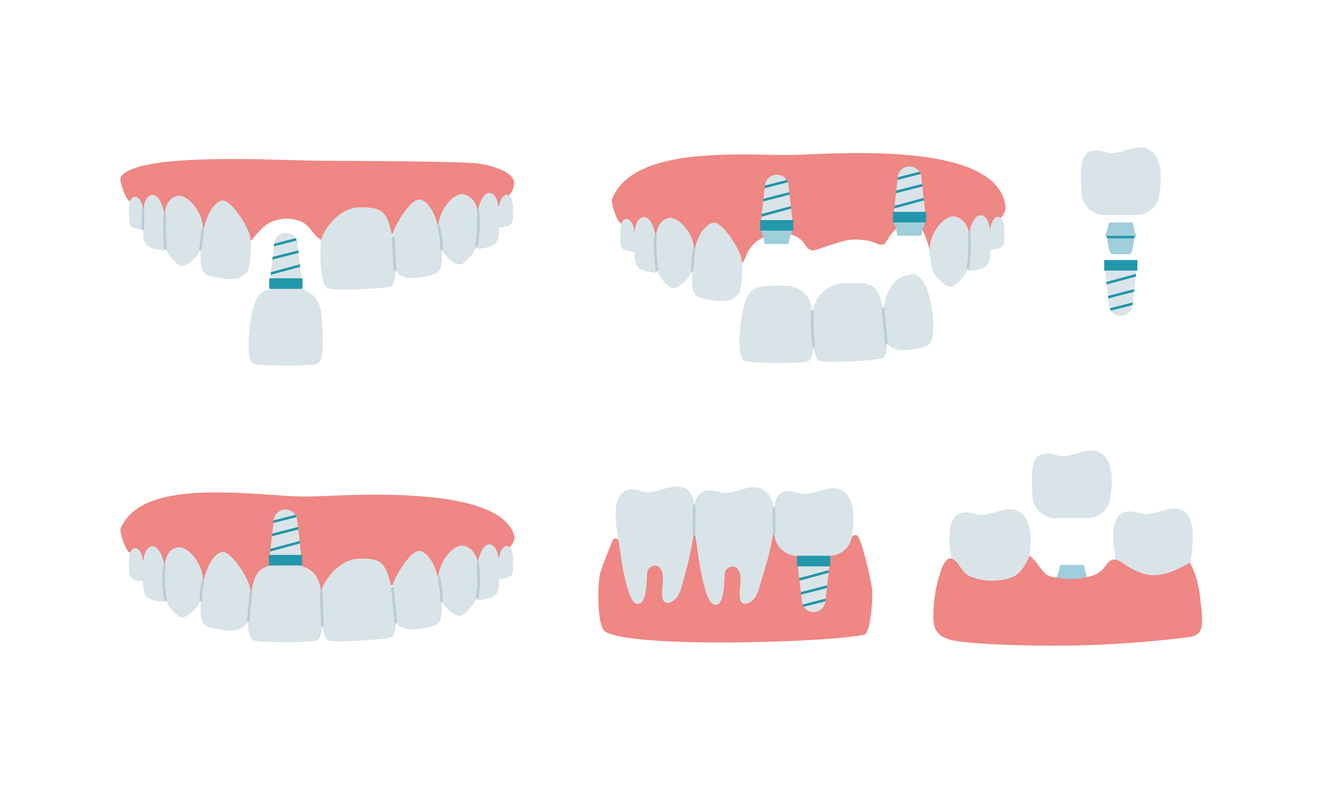Dental implants vs dental bridges.