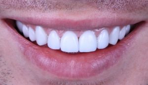 Close up of a man's smile with Lumineers in Boston from Dental Partners of Boston