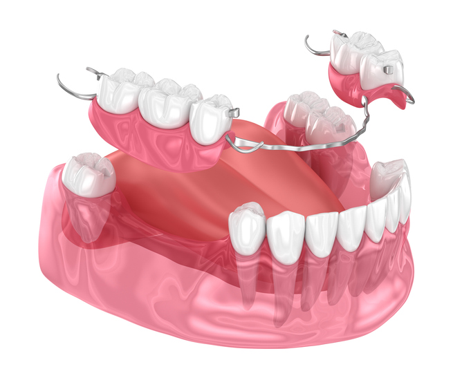 Removable partial denture