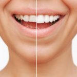 Veneers are beautiful; the perfect choice for straight and nicely shaped teeth.