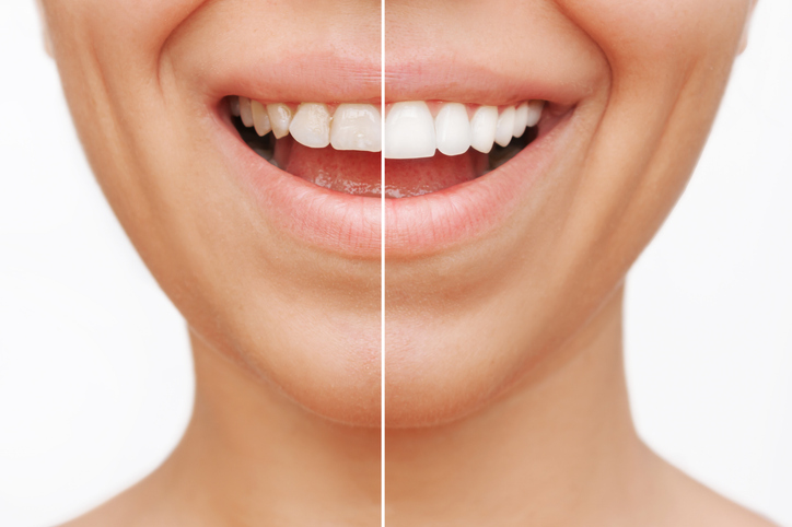 Veneers are beautiful; the perfect choice for straight and nicely shaped teeth.