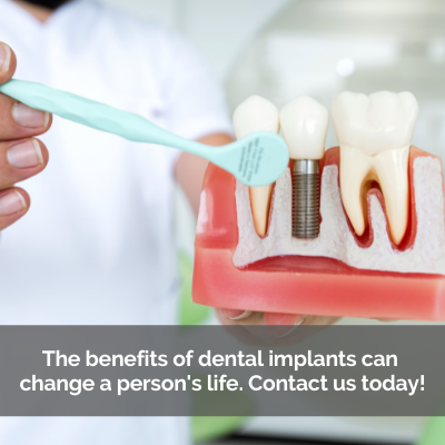 Cross section of dental implants. Caption: The benefits of dental implants can change a person's life. Contact us today!