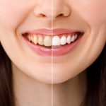 Smiling woman before and after the teeth whitening procedure, close-up image
