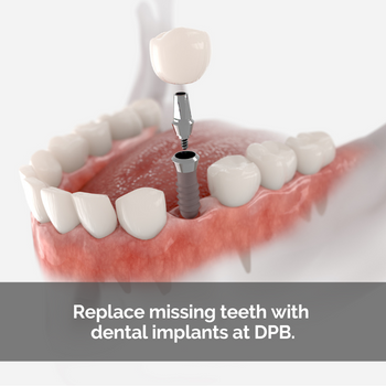 Dental implant 3d model. Replace missing teeth with dental implants at DPB