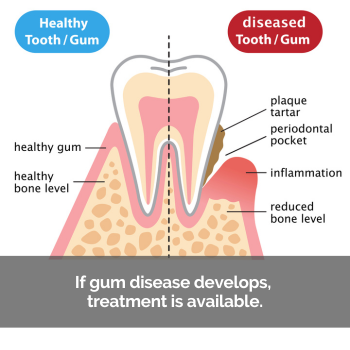 Diagram of the progression of gum disease.
