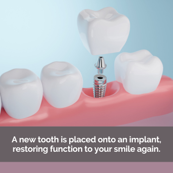 Vector image of a dental implant