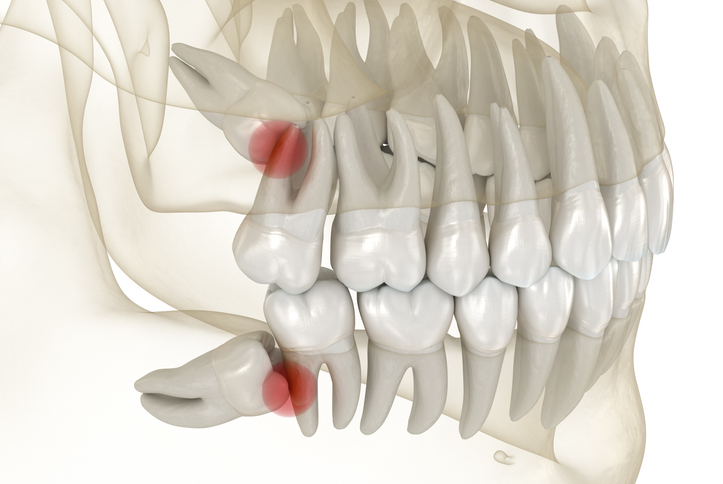 X-ray of wisdom teeth impaction