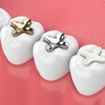 different types of tooth fillings