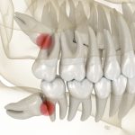 impacted teeth causing the need for tooth extraction treatment