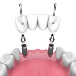 Dental bridge with four crowns supported by two dental implants