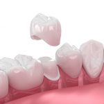 dental crown