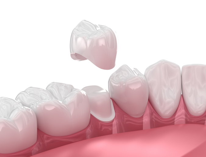 dental crown illustration