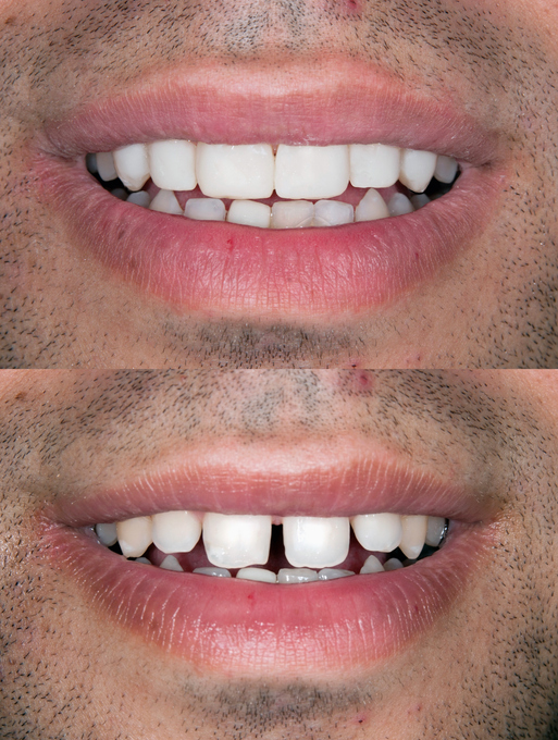 before and after dental veneers