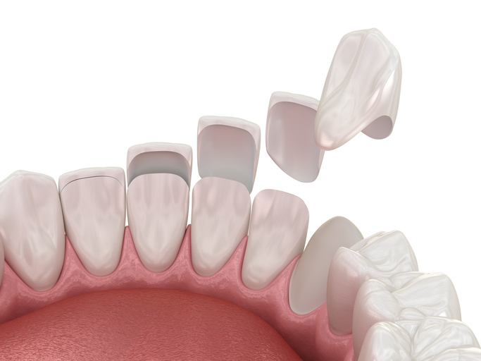 different types of veneers for teeth