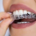 Invisalign aligners cosmetic teeth straightening
