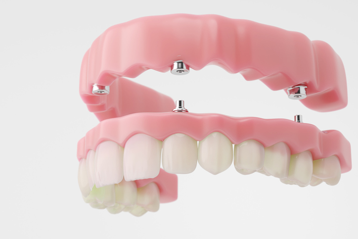 full snap-on dentures using four dental implants