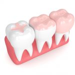 partial crowns: 3d render of teeth with inlay, onlay and crown filling over white background