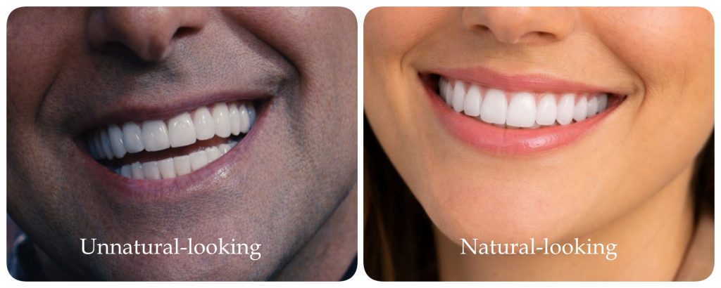 Unnatural vs Natural-looking cosmetic dentistry