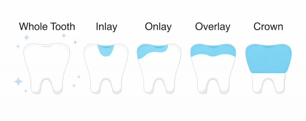 showing the difference between an inlay, onlay, overlay, and crown