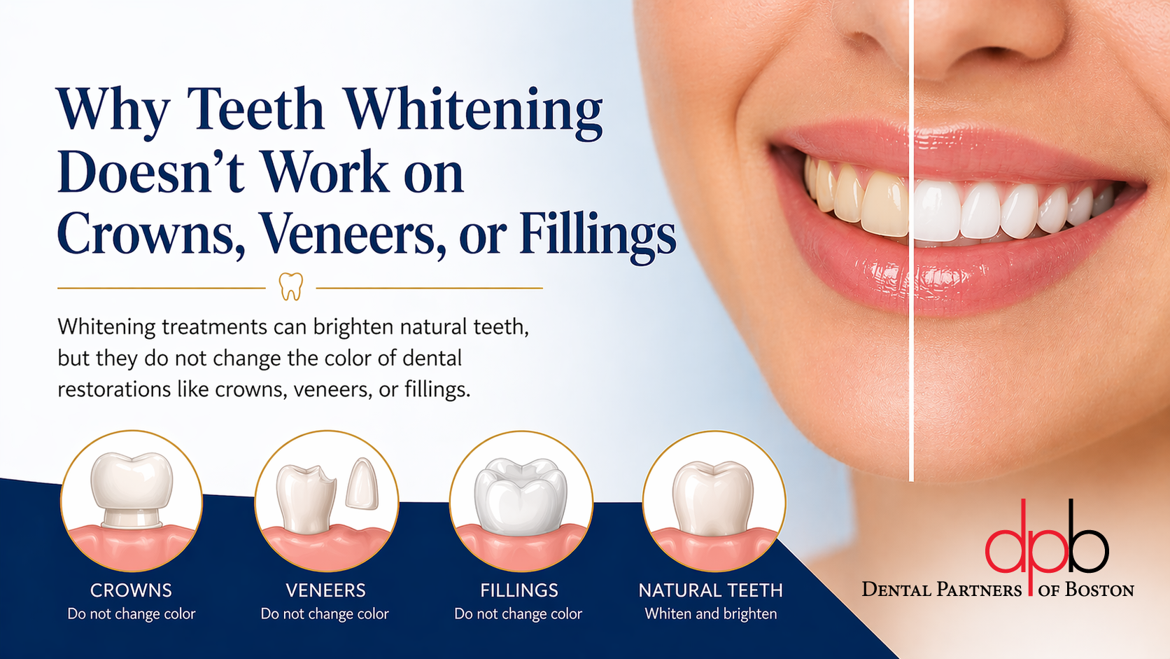 teeth whitening works on natural teeth enamel only