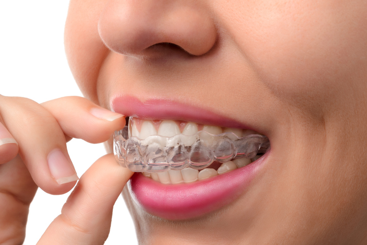 a woman placing a clear plastic retainer over her top teeth